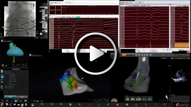 Navigating in ventricle for arrhythmias originating from LV Crux