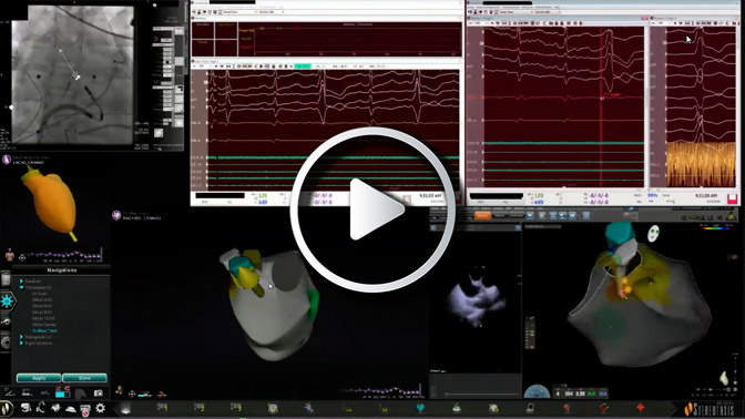 Navigates in Ventricle for Arrhythmias originating from LVOT - R-L Junction