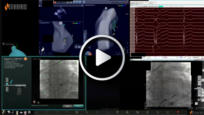 Navigating in the Ventricle for Arrhythmias Originating from the RVOT Freewall