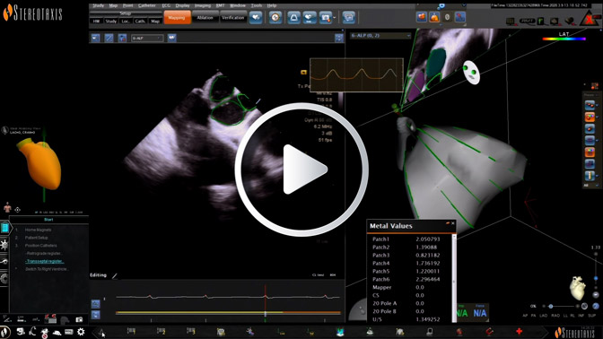 Navigation with Robotics for Ischemic VT Ablation