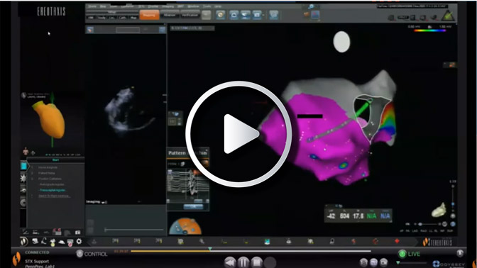 Ventricular Mapping with Robotics for Patient with Cardiac Sarcoidosis
